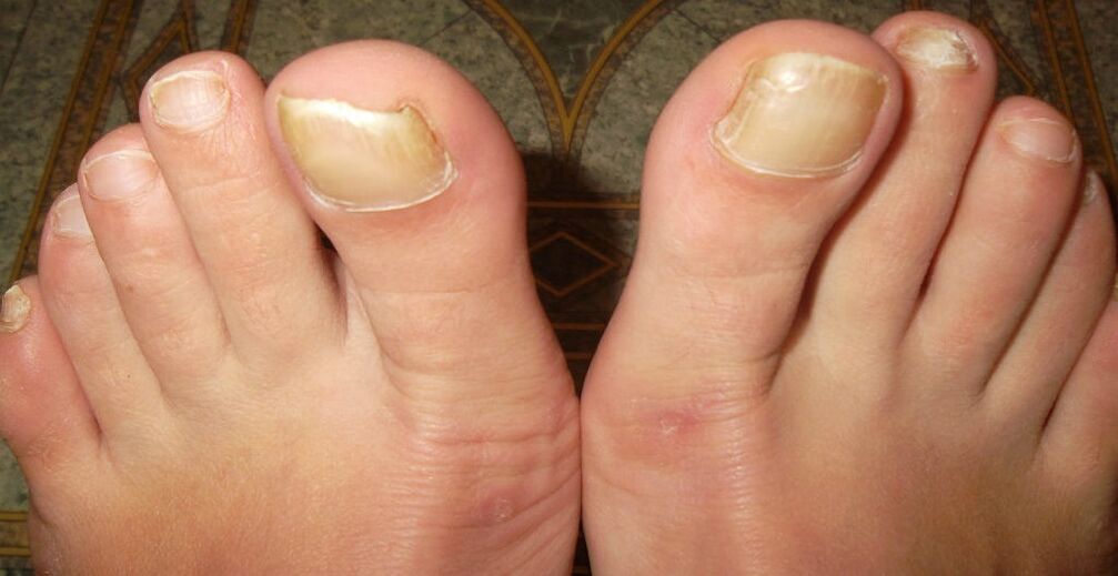 prime fasi del fungo dell'unghia del piede