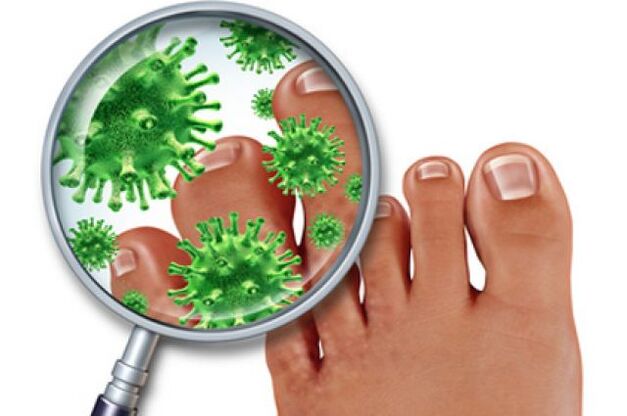infezione fungina sulle unghie dei piedi