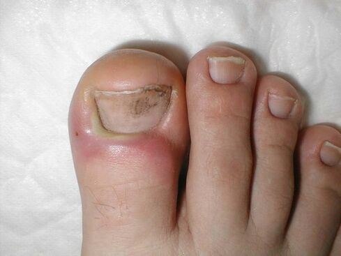 gocce per il trattamento del fungo dell'unghia del piede