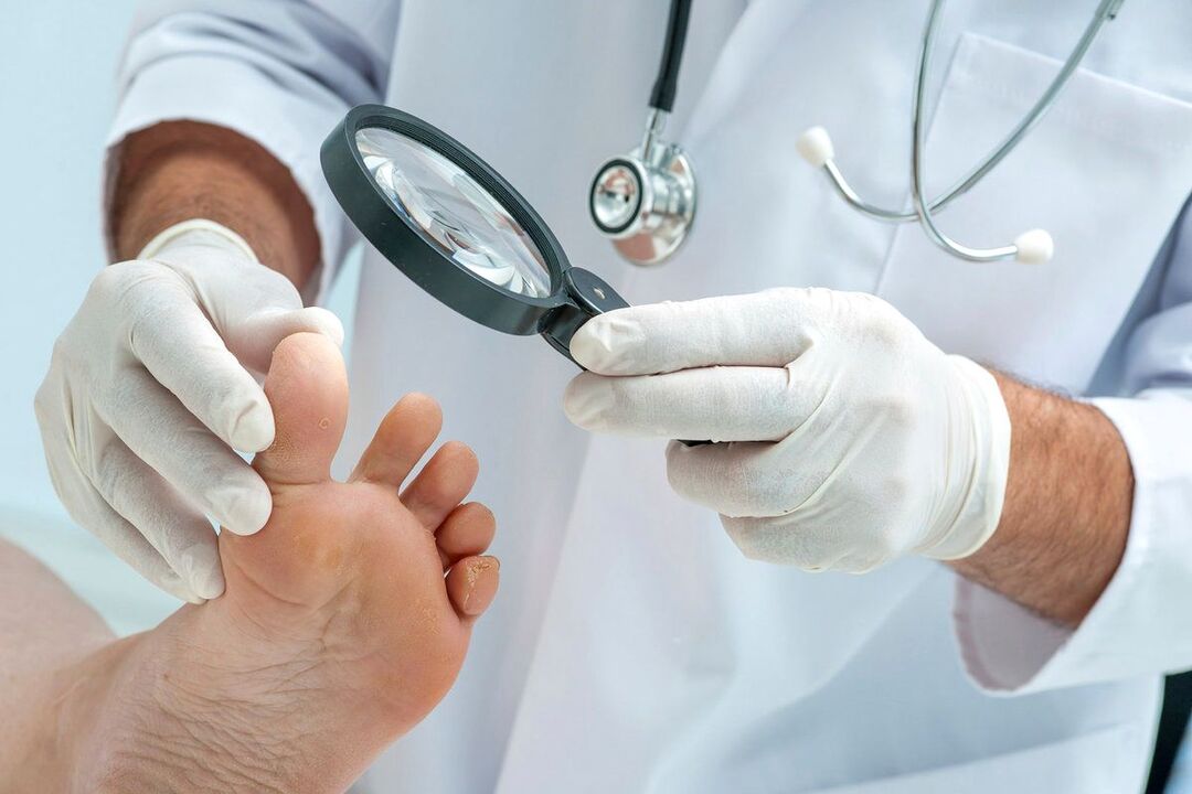 il medico esamina i piedi con il fungo