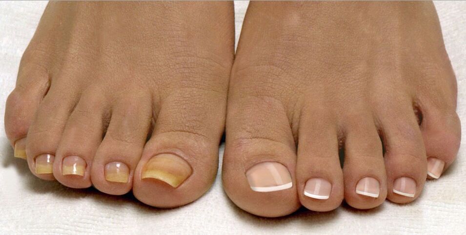 unghie sane e fungo dell'unghia del piede