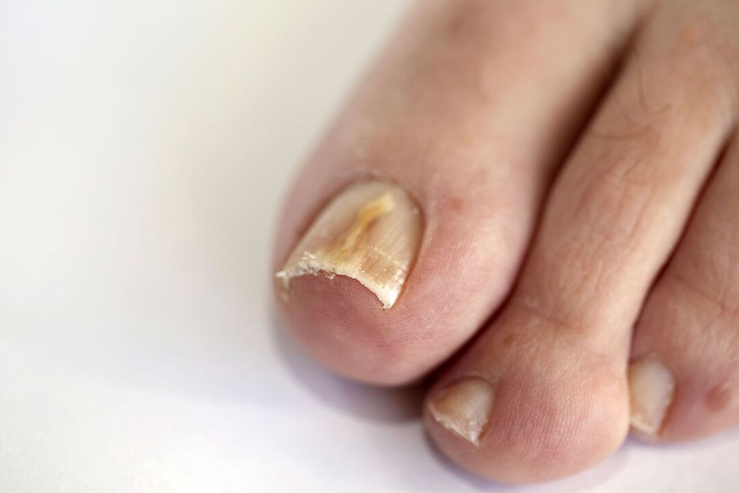 sintomi del fungo del piede
