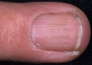 segni di fungo dell'unghia del piede