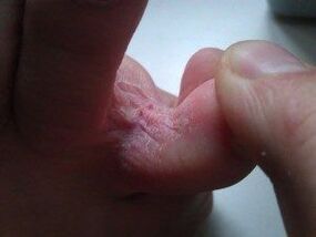 lesioni cutanee tra le dita dei piedi con un fungo