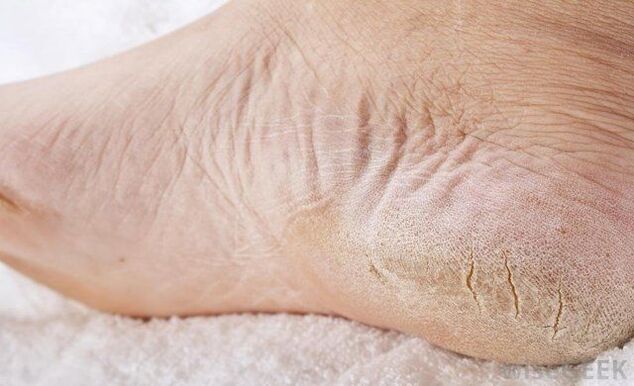 i piedi asciutti sono un segno di funghi