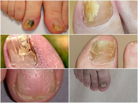 sintomi di infezione fungina delle unghie