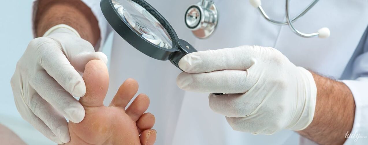 Il medico esamina il fungo in punta