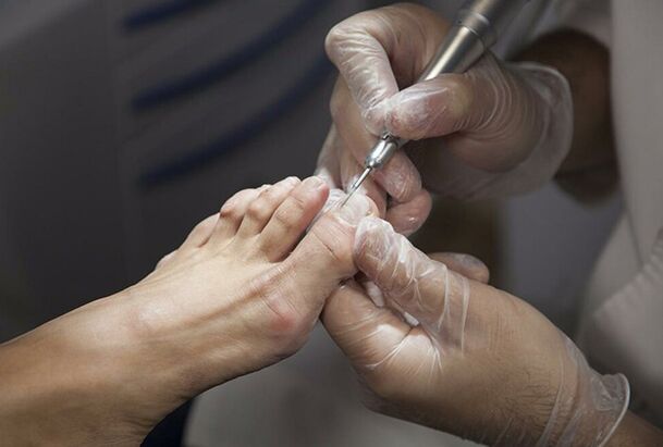 Diagnosi del fungo delle gambe
