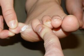 fungo sulle dita dei piedi