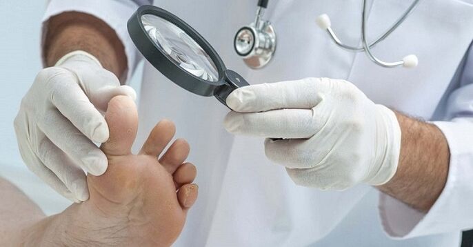 il medico esamina i piedi alla ricerca di funghi alle unghie