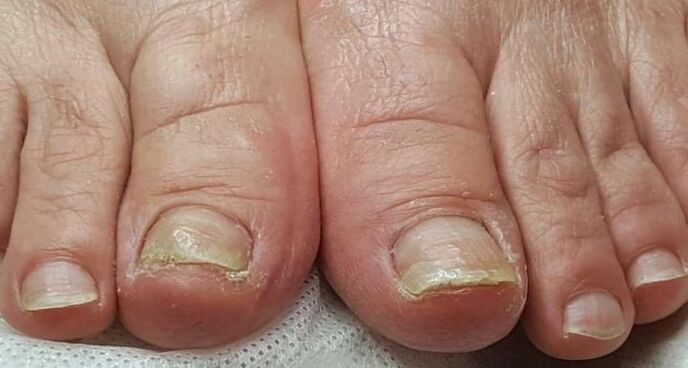 danni alle unghie con funghi sui piedi