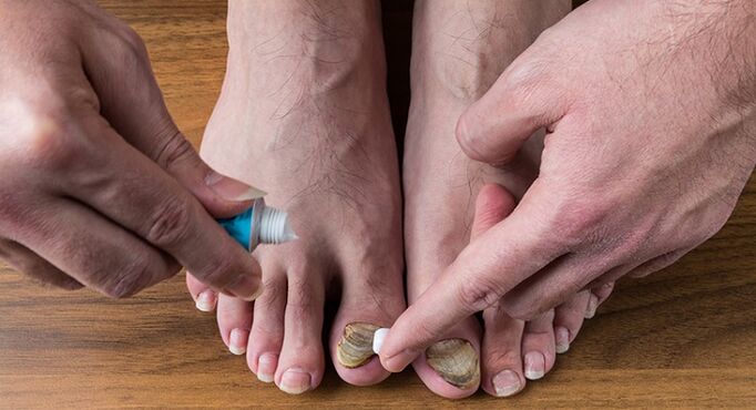 trattamento fungo dell'unghia del piede