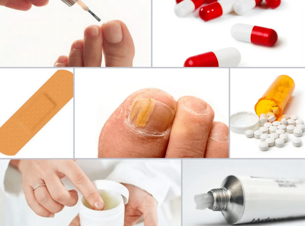 farmaci sistemici per il fungo dell'unghia del piede